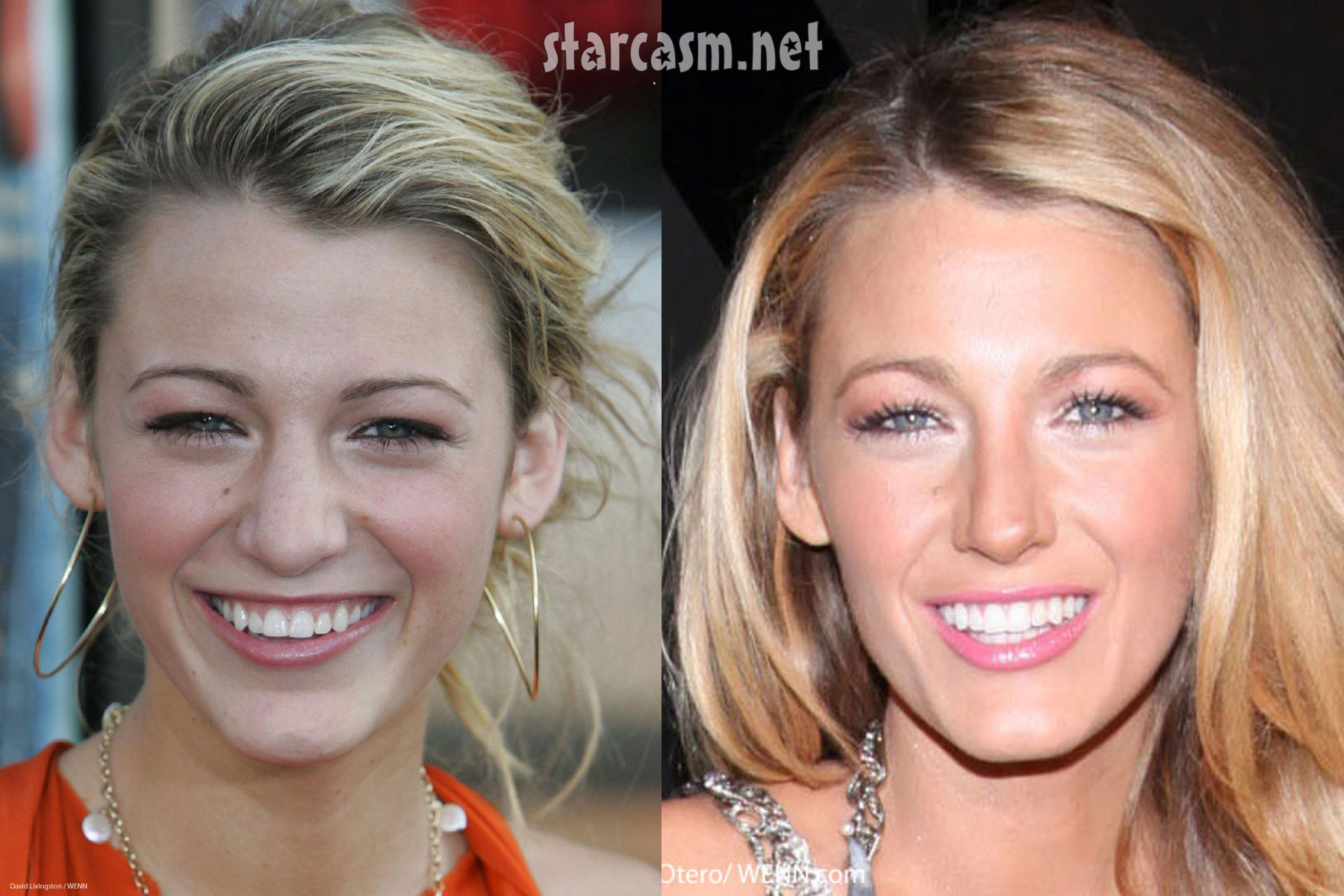Blake Lively's nose job before and after plastic surgery photos