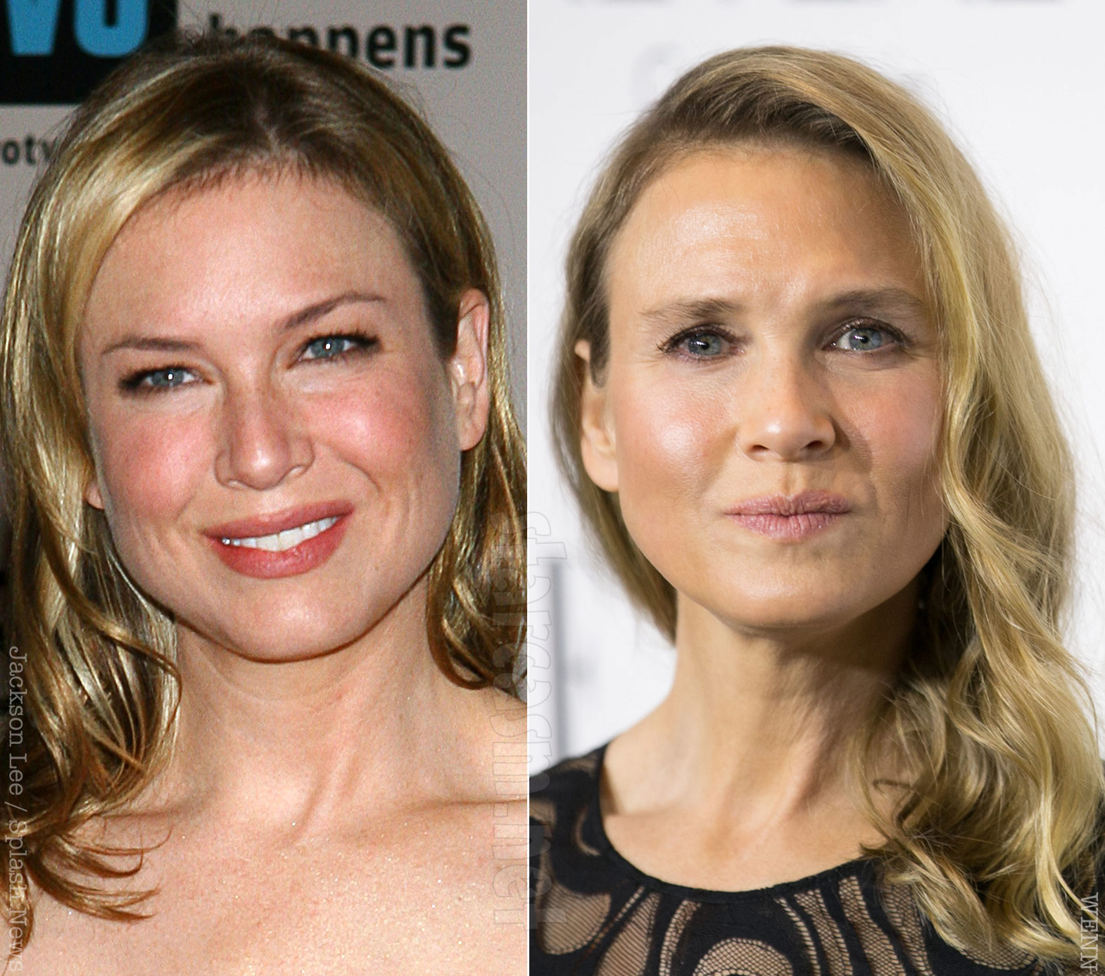 What happened to Renee Zellweger's face? Has she had plastic sugery?