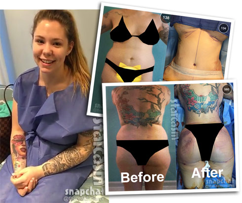 What Plastic Surgery Procedures Did Kailyn Lowry Have Done.