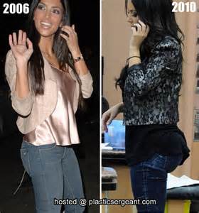 Is Kim Kardashian S Butt Fake Or Real Before And After Butt Implants