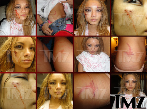 Tila Tequila Gathering of the Juggalos injury photos