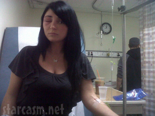Angelina Pivarnick in the hospital with a spide bite on her eye