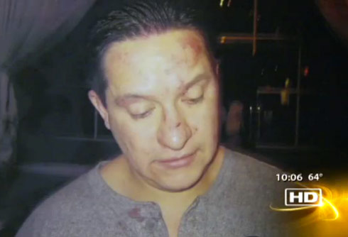 Adolfo Arreola's wounds after allegedly being beat up by cast of Real Housewives of New Jersey