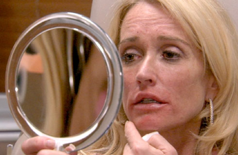 RHOBH Kim Richards lip injection