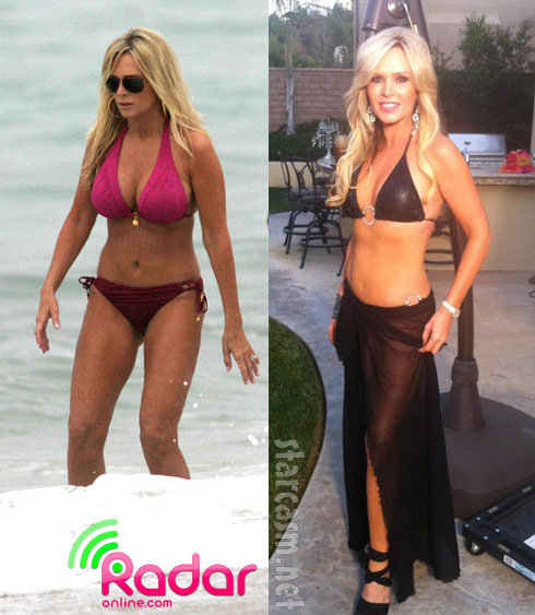 Tamra Barney before and after breast implant removal surgery photos