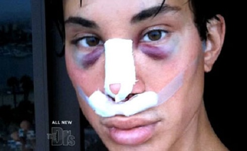 Justin Jedlica plastic surgeries