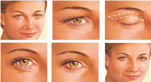 What are webbed eyes?