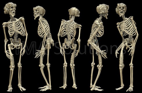 The Elephant Man Joseph Merrick's skeleton