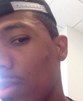 Nick Cannon’s pimple turned out to be a grape-sized cyst