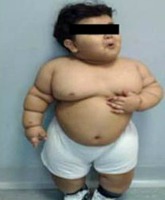 Obese 2-year-old becomes youngest gastric bypass patient
