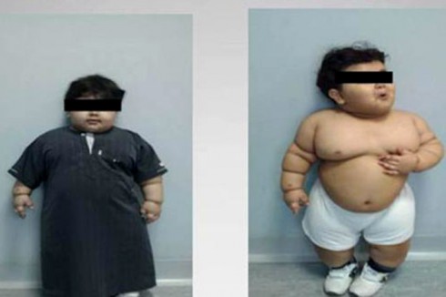 Youngest Gastric Bypass Patient