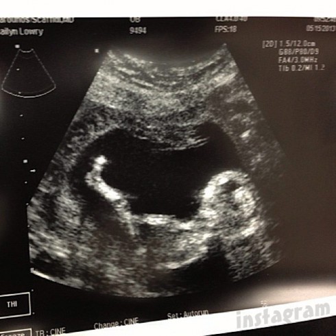 PHOTO Kailyn Lowry sonogram