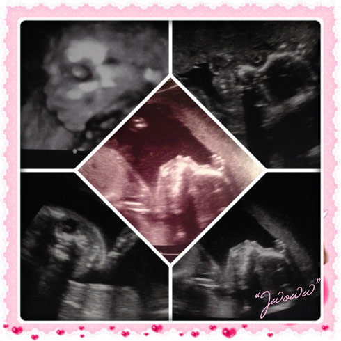 JWOWW Ultrasound photo