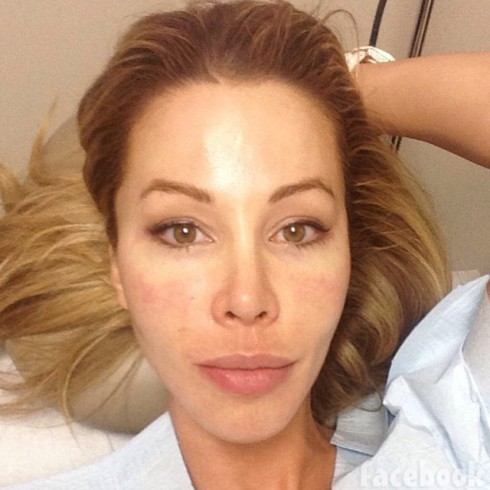Lisa Hochstein no makeup after a vampire facial