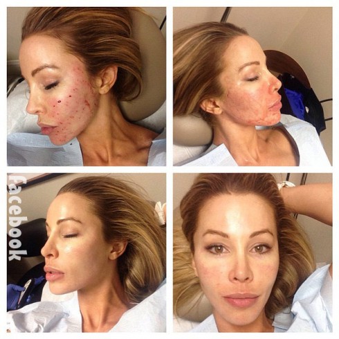 Lisa Hochstein vampire facial photos