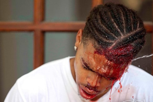 PHOTOS VIDEO Charlottesville victim Deandre Harris speaks after attack: ‘They were beating me with poles’