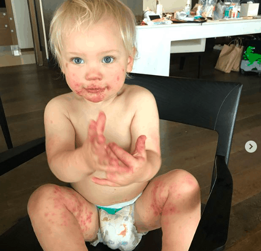 Pink’s 1-year-old son Jameson is suffering from hand, foot, and mouth disease while she’s on tour