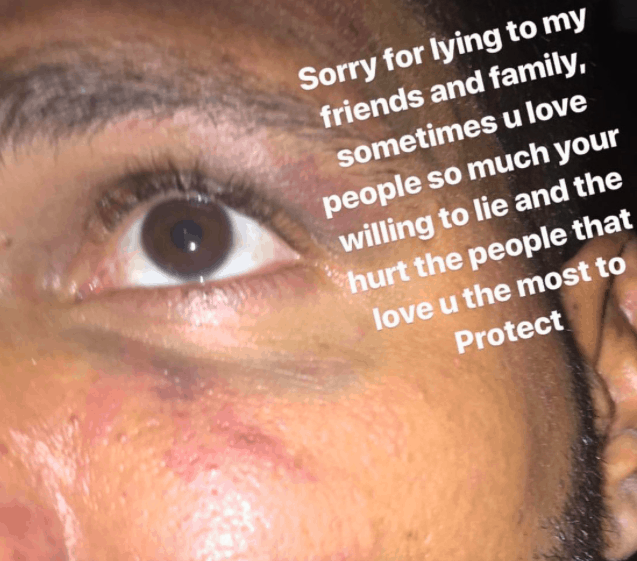 JERSEY SHORE Ronnie Ortiz-Magro allegedly got a black eye from girlfriend Jen Harley (photo)
