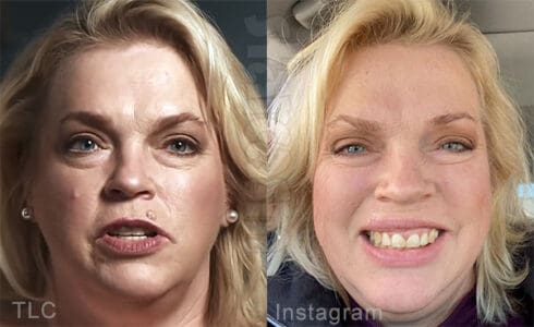 SISTER WIVES Janelle Brown has cancer removed from lip, says ‘all is