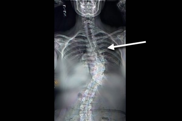 SISTER WIVES Why Ysabel had to get her back surgery during the COVID-19 pandemic