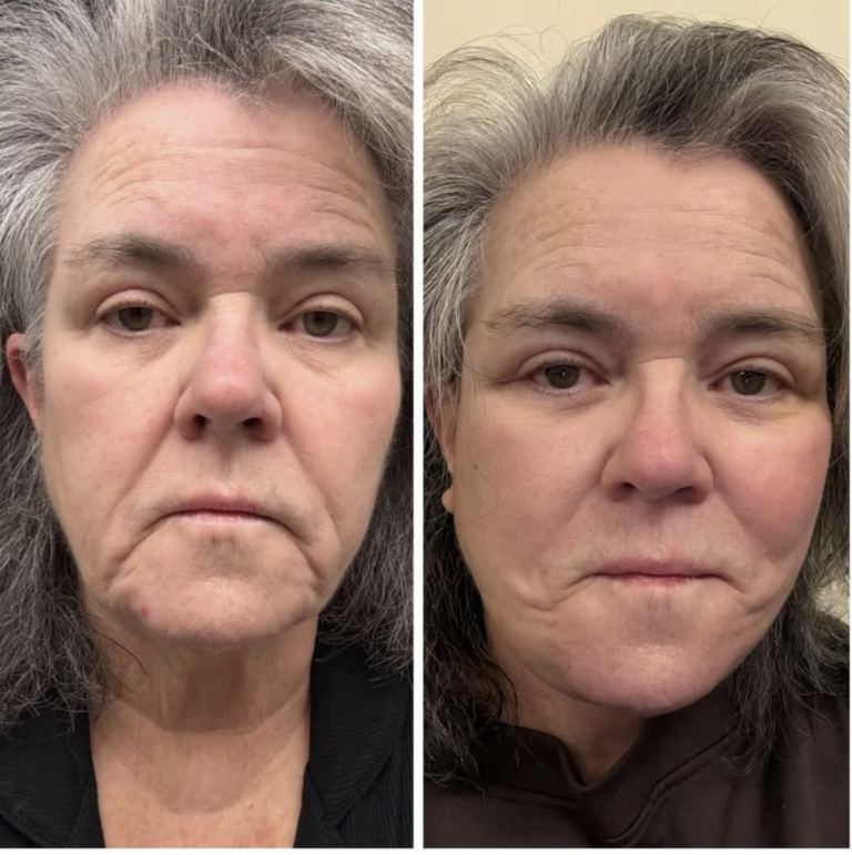 BEFORE AND AFTER: Rosie O’Donnell got a facelift at age 64 after years of publicly opposing cosmetic surgery